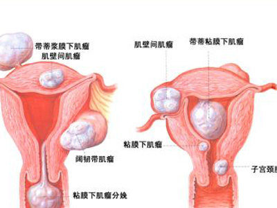 惡性子宮肌瘤癥狀有哪些