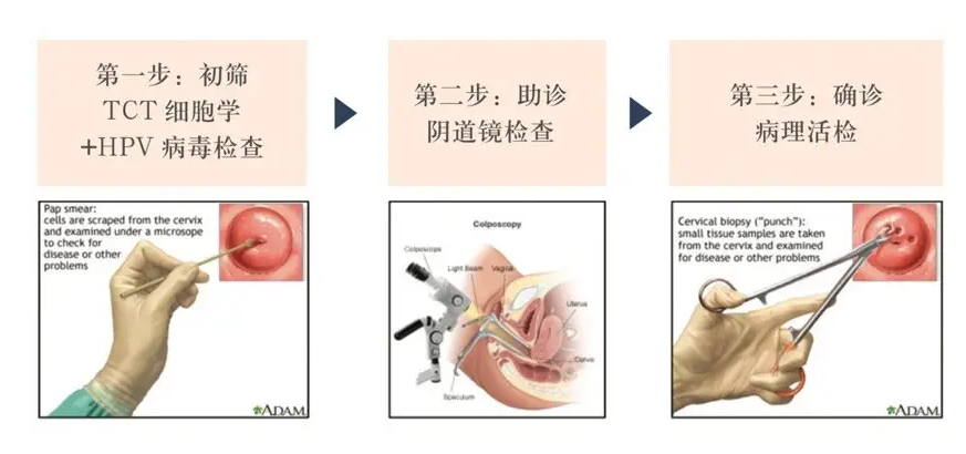 什么情況下需要宮頸活檢？一文說清宮頸活檢的意義